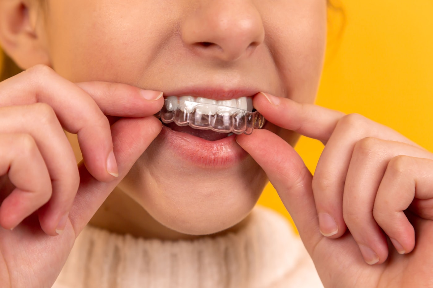 Patient placing dental aligners after a booked consultation